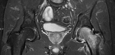 Coronal stir imaging in transient osteoporosis, showing diffuse edema.[1]