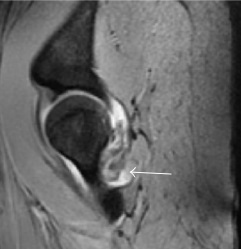 Sagittal T2* gradient echo image showing a posterior soft tissue mass with hypointense areas secondary to hemosiderin deposition.[1]