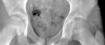 Figure 2C. AP view of a patient with left hip effusion secondary to trauma showing widening of the medial joint space.[1]