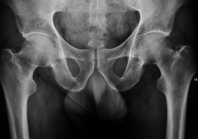 X-ray of a patient with transient osteoporosis of the left hip showing osteoporosis.[1]