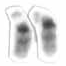 Chromosome 22 mutations cause 22q13 syndrome