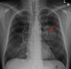 LungCACXR