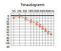 Tonaudiogramm, Schallempfindungsstörung