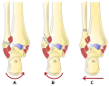 Fractura fibulae typorum A, B, C.