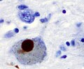 Thumbnail for Synucleinopathy