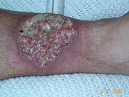 Pyoderma gangraenosum aan het been bij een patiënt met de ziekte van Crohn, met paarse opgeworpen wondranden.