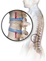 Vertebral compression fracture Attribution 3.0 Unported license, attributed to Blausen Medical and Mikael Häggström