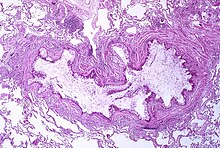 A tissue cross section of the airway showing a stained pink wall and an inside full of white mucous