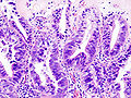 Gallbladder adenocarcinoma histopathology