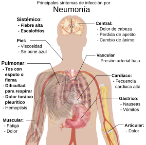 Principales síntomas de la neumonía infecciosa.