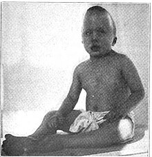 Fotografia anteroposterior d'un pacient infantil d'escafocefàlia el 1923.