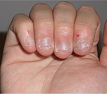 Multiple, dystrophic, irregular, shortened fingernails