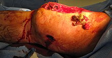 exposed shotgun wound at knee, exposed flesh