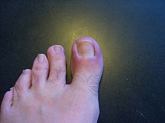 Toenail that FINALLY had avulsion on both sides, 18 days later