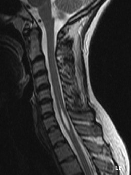 Description de l'image syringomyelia.jpg.