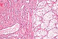 Clear-cell renal-cell carcinoma. HE, × 100