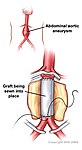 Wstawka z protezy dakronowej w leczeniu tętniaka aorty brzusznej