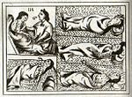 Thumbnail for History of smallpox in Mexico