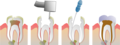 Root canal illustration