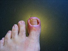 Toenail that twice had failed wedge resections on both sides