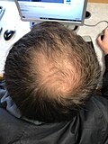 Thumbnail for Pattern hair loss