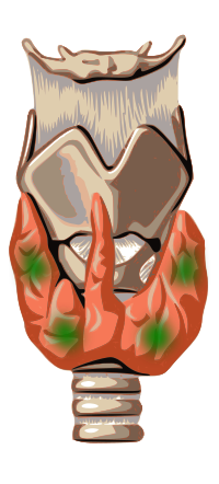 Thumbnail for Parathyroid carcinoma