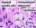 Histopathology of liposarcoma, H&E stain, with the main features:[5] - Spindle cells with enlarged, hyperchromatic nuclei. - Apparently univacuolated adipocytes (may look normal). - Lipoblasts (multivacuolated), but neither necessary nor sufficient for diagnosis of liposarcoma.