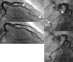 Angiogram showing myocardial bridging resulting in arterial compression.