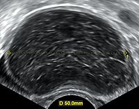 Hemorrhagic ovarian cyst