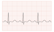 Tachycardia ECG paper.svg