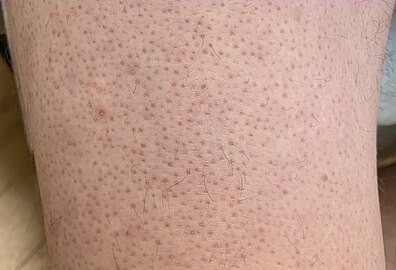 Keratosis pilaris on lower extremity