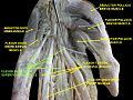 Dissection de la main, en vert le muscle fléchisseur superficiel des doigts de la main.