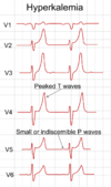 ECG in hyperkalemia