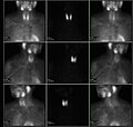 Thumbnail for Sestamibi parathyroid scan