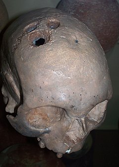 Bronzkori trepanáció