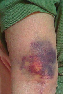 Discharge Bruising Two.jpg