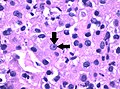 Grade 3: Arrows point at a clearly visible nucleolus.