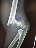 Thumbnail for Supracondylar humerus fracture