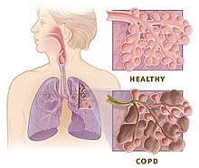 Lungs affected by COPD