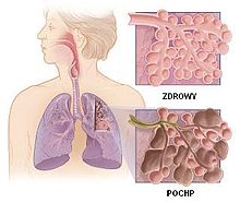 Lungs affected by COPD