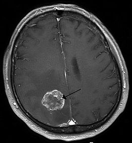 Afbeelding van een MRI-scan van een uitzaaiing van longkanker in de rechterhersenhelft (L=links, P=occipitaal, achterkant van het hoofd).