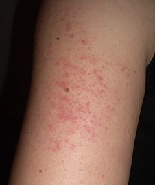 Keratosis pilaris arm