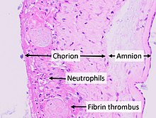 Histopathology of chorioamnionitis.jpg