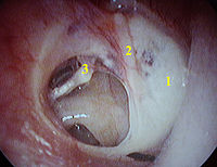 Geperforeerd trommelvlies (van linkeroor): 1 - Tympanosclerose, 2 - Hamer, 3 - bovenkant van stijgbeugel