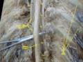 Spinal cord. Spinal membranes and nerve roots.Deep dissection. Posterior view.