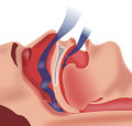 Thumbnail for Obstructive sleep apnea