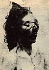 Mortuary photograph of Eddowes. Her lower face is severely mutilated