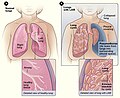 Thumbnail for Lymphangioleiomyomatosis