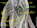 Deep palmar arterial arch