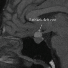 Rathke's cleft cyst